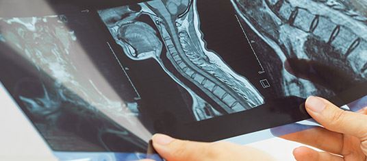 Spinal Cord Injuries